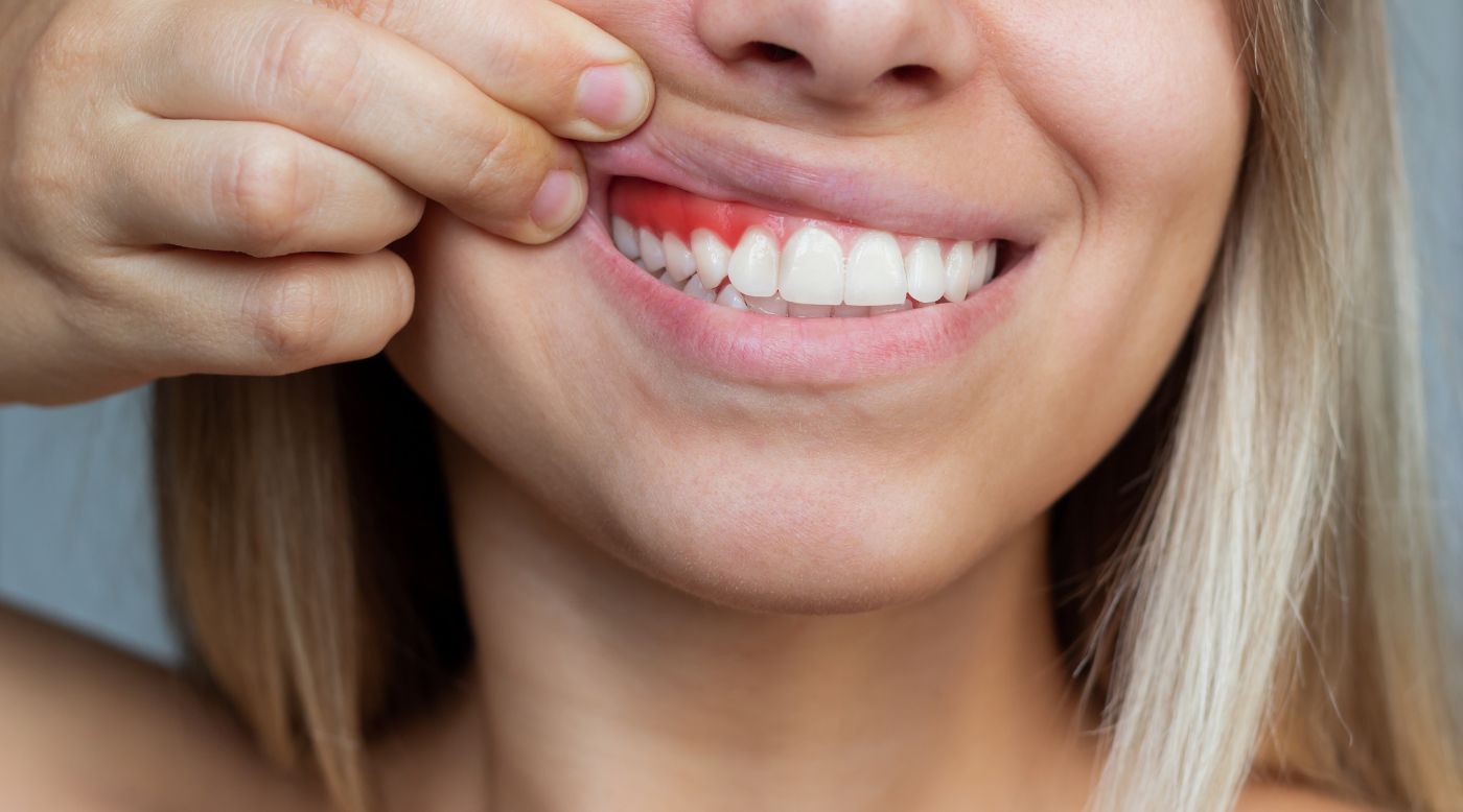 Frau mit rotem Zahnfleisch
